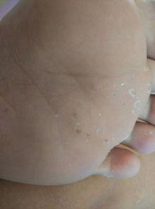 脚底长肉丁图片,揭秘脚底肉丁成因与护理攻略